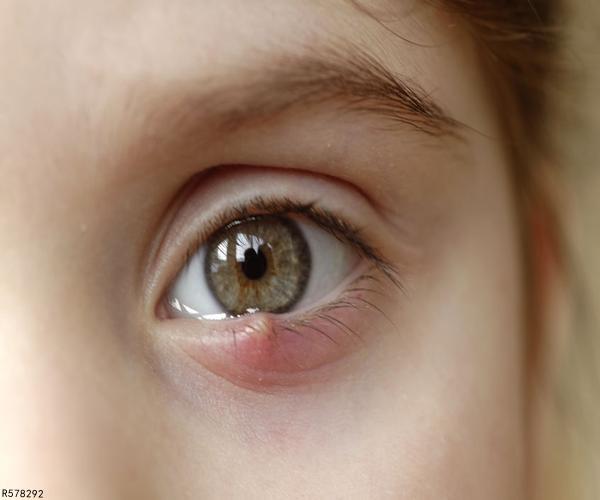 麦粒肿在生活中被称之为针眼,主要出现在眼睛下面的睫毛部位会有疼痛
